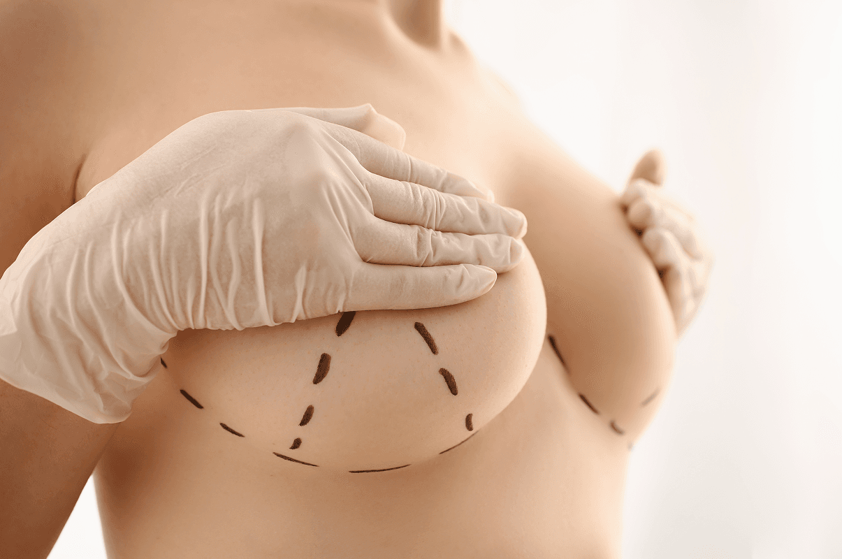 Mamoplastia